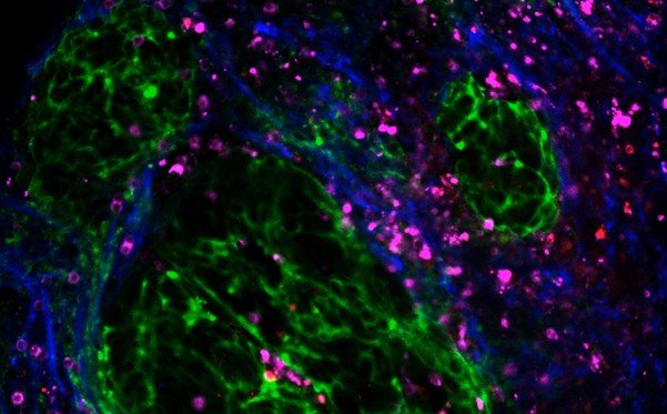 microscope image of a biopsy of high-grade serous ovarian cancer. Green cells are malignant cells clustered together, the extracellular matrix is blue and the immune cells are pink and red