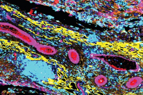 microscopic image of ovarian cancer cells, blood vessels, immune cells and structural surrounding tissues