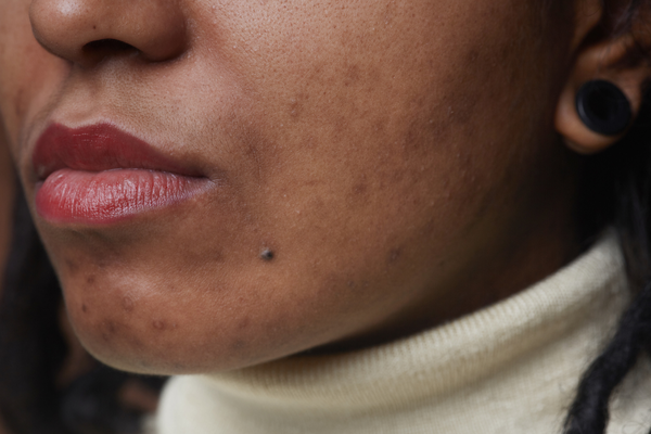 Black woman with acne scars